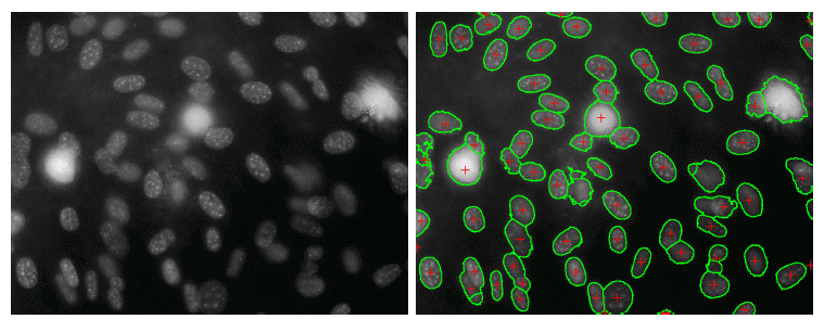 fig 1: Cancerous cell detection 